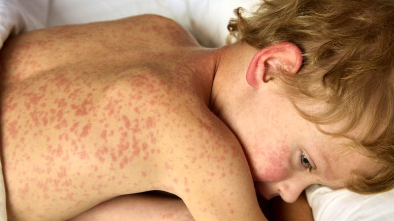 Hausse préoccupante des cas de rougeole en France : une épidémie en progression en 2025