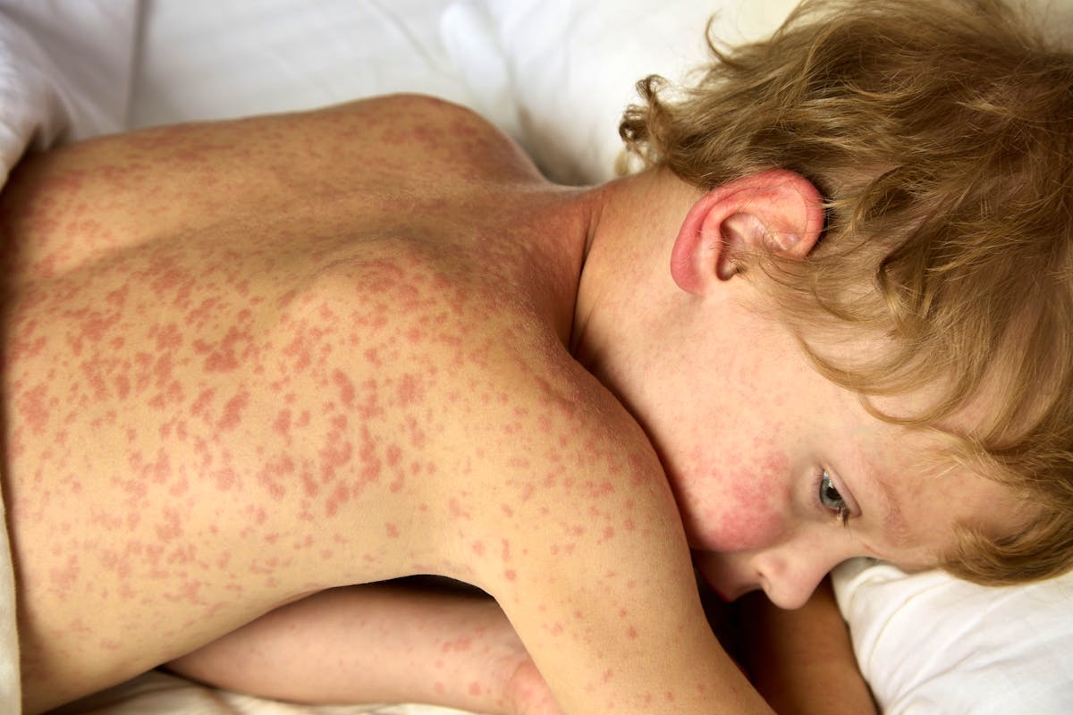 Hausse préoccupante des cas de rougeole en France : une épidémie en progression en 2025